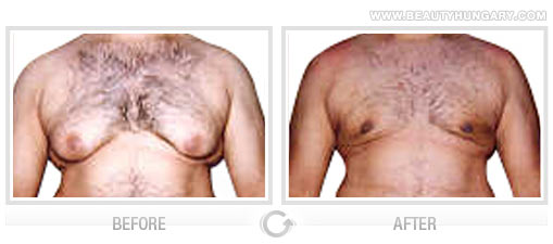 Manhattan breast reduction
